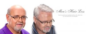 men hair loss